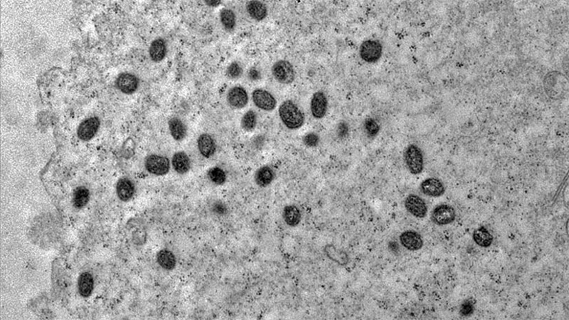 Imagem 1 - SMS de Mossoró emite novo alerta sobre transmissão e prevenção à Varíola dos Macacos. A doença infectocontagiosa é causada pelo vírus Monkepypox (PPXV). Apesar de ser chamada de varíola dos macacos, ela não é transmitida por esse animal. Os sintomas mais comuns são febre de início súbito, aparecimento de lesões na pele (pode ser única ou várias), aparecimento de linfonodos (íngua), dores no corpo e fraqueza profunda. Os modos de transmissão são: por meio de contato próximo/íntimo com uma pessoa doente (infectada pelo vírus Monkeypox) e com lesões de pele. Imagem 1 - SMS de Mossoró emite novo alerta sobre transmissão e prevenção à Varíola dos Macacos. A doença infectocontagiosa é causada pelo vírus Monkepypox (PPXV). Apesar de ser chamada de varíola dos macacos, ela não é transmitida por esse animal. Os sintomas mais comuns são febre de início súbito, aparecimento de lesões na pele (pode ser única ou várias), aparecimento de linfonodos (íngua), dores no corpo e fraqueza profunda. Os modos de transmissão são: por meio de contato próximo/íntimo com uma pessoa doente (infectada pelo vírus Monkeypox) e com lesões de pele.