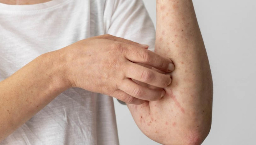Imagem 1 - Saiba como proceder em caso de diagnóstico positivo de monkeypox. O Rio Grande do Norte tem 68 casos confirmados de monkeypox, de acordo com o boletim mais recente. Conforme explica a Sesap, é importante informar a população em geral de que a monkeypox pode se espalhar para qualquer pessoa por meio de contato próximo, pessoal. Várias medidas podem ser adotadas para evitar a contaminação, como higienizar com frequência as mãos com álcool 70% ou com água e sabão, evitar contato próximo com pessoas que possam apresentar quadro clínico compatível, evitar compartilhamento de objetos, incluindo roupas de cama e toalhas, e reduzir o número de parceiros sexuais nesse momento. Imagem 1 - Saiba como proceder em caso de diagnóstico positivo de monkeypox. O Rio Grande do Norte tem 68 casos confirmados de monkeypox, de acordo com o boletim mais recente. Conforme explica a Sesap, é importante informar a população em geral de que a monkeypox pode se espalhar para qualquer pessoa por meio de contato próximo, pessoal. Várias medidas podem ser adotadas para evitar a contaminação, como higienizar com frequência as mãos com álcool 70% ou com água e sabão, evitar contato próximo com pessoas que possam apresentar quadro clínico compatível, evitar compartilhamento de objetos, incluindo roupas de cama e toalhas, e reduzir o número de parceiros sexuais nesse momento.