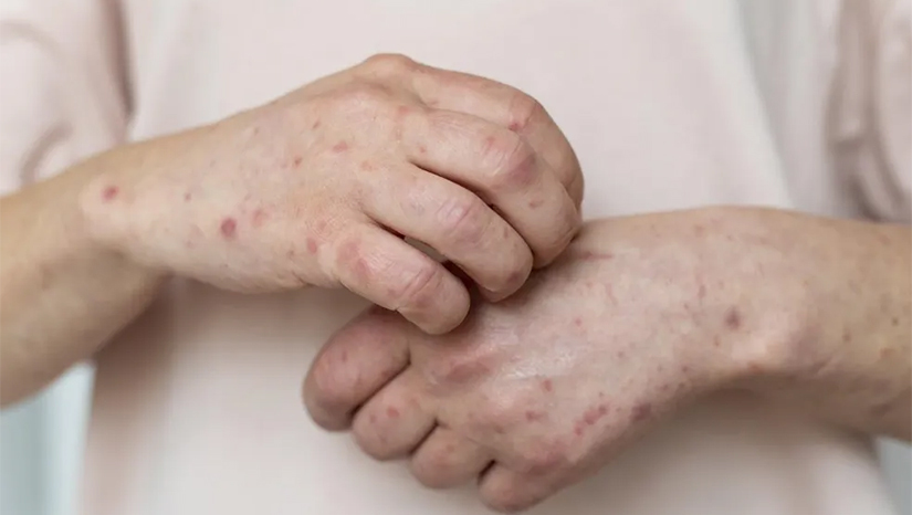 Imagem 1 - Dos 102 casos confirmados no Rio Grande do Norte, 84 são homens e 18, mulheres. Segundo a Sesap, Natal concentra a maioria dos casos, com 64 pessoas diagnosticadas com a doença. Em seguida aparecem as cidades de Parnamirim (16) e Extremoz (4). No Rio Grande do Norte, o primeiro caso de varíola dos macacos foi confirmado no dia 1º de julho. Em agosto o governo do estado lançou um plano de contingência para prevenção e combate à disseminação da doença. Imagem 1 - Dos 102 casos confirmados no Rio Grande do Norte, 84 são homens e 18, mulheres. Segundo a Sesap, Natal concentra a maioria dos casos, com 64 pessoas diagnosticadas com a doença. Em seguida aparecem as cidades de Parnamirim (16) e Extremoz (4). No Rio Grande do Norte, o primeiro caso de varíola dos macacos foi confirmado no dia 1º de julho. Em agosto o governo do estado lançou um plano de contingência para prevenção e combate à disseminação da doença.