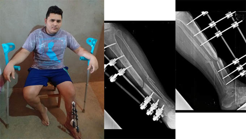 Imagem 1 - Na prática, o que ocorreu é que o HRTM, após fazer o primeiro atendimento, mandou Natanael Costa para casa, aguardar ser chamado para fazer a cirurgia eletiva, ou seja, retirada do fixador e colocado as placas na fibula e tíbia quebrados no acidente. Só que esqueceu. Agora, a esposa de Natanael, Fernanda Costa, cansada de esperar, pediu ajuda na Secretaria Municipal de Saúde. Natanael foi incluído Central de Regulação para fazer a cirurgia pelo SUS, só que ela ou ele não tem qualquer noção de quando isto vai acontecer. Imagem 1 - Na prática, o que ocorreu é que o HRTM, após fazer o primeiro atendimento, mandou Natanael Costa para casa, aguardar ser chamado para fazer a cirurgia eletiva, ou seja, retirada do fixador e colocado as placas na fibula e tíbia quebrados no acidente. Só que esqueceu. Agora, a esposa de Natanael, Fernanda Costa, cansada de esperar, pediu ajuda na Secretaria Municipal de Saúde. Natanael foi incluído Central de Regulação para fazer a cirurgia pelo SUS, só que ela ou ele não tem qualquer noção de quando isto vai acontecer.