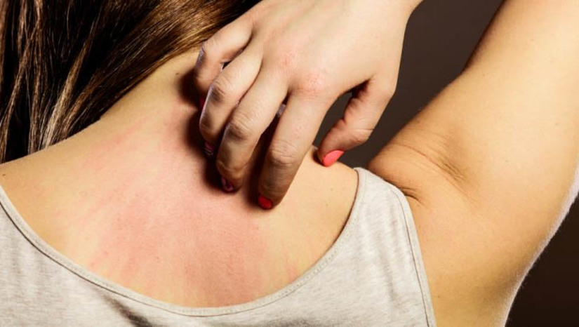Imagem 1 - Como se livrar da coceira na nuca: 4 Dicas. Pois existem vários fatores que podem causar problemas na pele. Até mesmo na região do couro cabeludo. Um dos casos é a foliculite queloidiana, um tipo de inflamação de pelos encravados na nuca. O que explica a cabeça coçando e cabelo caindo, viu? Imagem 1 - Como se livrar da coceira na nuca: 4 Dicas. Pois existem vários fatores que podem causar problemas na pele. Até mesmo na região do couro cabeludo. Um dos casos é a foliculite queloidiana, um tipo de inflamação de pelos encravados na nuca. O que explica a cabeça coçando e cabelo caindo, viu?