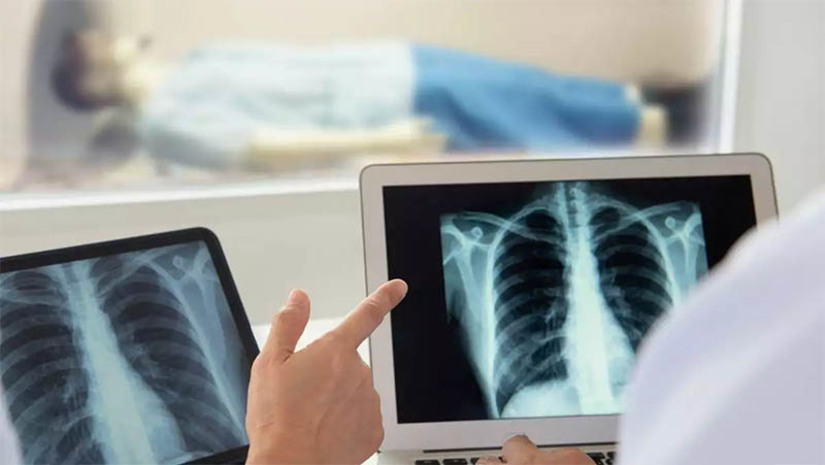 Imagem 1 - Combate ao Câncer de Pulmão: Liga Mossoroense realizará 100 tomografias e consultas gratuitas. A ação visa a prevenção e conscientização sobre este tipo de câncer, o mais comum no mundo, com 2,5 milhões de novos casos, segundo a Organização Mundial da Saúde (OMS). O público-alvo são pessoas entre 50 e 80 anos, fumantes ou ex-fumantes dos últimos 15 anos. Os interessados devem se dirigir até o Hospital da Liga, que funciona na antiga Casa de Saúde Santa Luzia, na Praça dos Hospitais, de segunda a sexta, levando cartão do SUS, RG, CPF e comprovante de residência (originais e cópias). Imagem 1 - Combate ao Câncer de Pulmão: Liga Mossoroense realizará 100 tomografias e consultas gratuitas. A ação visa a prevenção e conscientização sobre este tipo de câncer, o mais comum no mundo, com 2,5 milhões de novos casos, segundo a Organização Mundial da Saúde (OMS). O público-alvo são pessoas entre 50 e 80 anos, fumantes ou ex-fumantes dos últimos 15 anos. Os interessados devem se dirigir até o Hospital da Liga, que funciona na antiga Casa de Saúde Santa Luzia, na Praça dos Hospitais, de segunda a sexta, levando cartão do SUS, RG, CPF e comprovante de residência (originais e cópias).