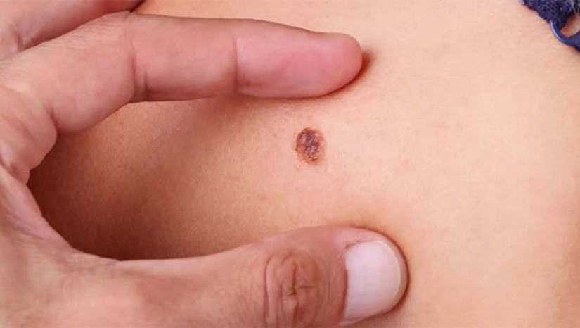 Imagem 1 -  A ação é promovida pela Sociedade Brasileira de Dermatologia – Regional Rio Grande do Norte( SBD/RN), e acontece Policlínica Medsaúde, na Rua Rosineide Alves Medeiros, 56 - Pres. Costa e Silva. O número de atendimento é limitado, serão distribuídas fichas a partir das 7h.  A ação será gratuita. O câncer de pele é o tipo mais frequente no Brasil, mas pode ser prevenido com medidas simples. O Instituto Nacional  do Câncer (INCA), estima  a incidência de 704 mil casos de câncer por ano no Brasil até 2025.