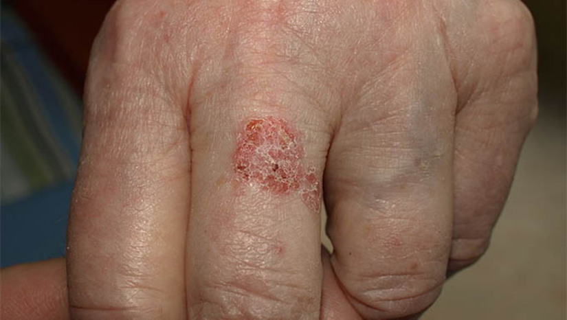 Imagem 1 -  Dermatologista alerta sobre cuidados para evitar o câncer de pele com a chegada do verão. O câncer de pele é um dos tipos mais comuns no Brasil. Dentro dessa categoria, o tipo “não melanoma” é o mais incidente entre todos os tumores malignos, representando 31% dos casos, segundo a Sociedade Brasileira de Dermatologia (SBD). Com a aproximação do verão e o aumento da exposição solar, a dermatologista Livia Rodrigues, da rede de clínicas Meu Doutor Novamed, traz orientações importantes para os cuidados com a pele e faz alertas sobre a prevenção.