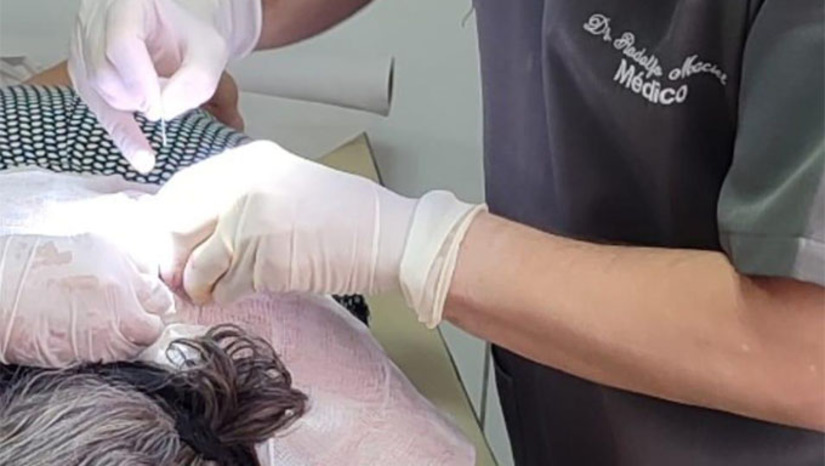   A ação prestou atendimento especializado a 22 pacientes, resultando na remoção segura de mais de 50 lesões de pele e garantindo que os cidadãos recebessem o cuidado necessário dentro do próprio município.  O serviço elimina a necessidade de deslocamento para cidades vizinhas, garantindo acesso rápido a procedimentos essenciais. O mutirão possui impacto direto na saúde preventiva, pois as cirurgias são vitais para a descoberta precoce e a prevenção do avanço de doenças, como o câncer de pele.