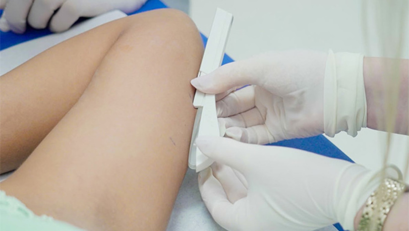   O Implanon é um implante hormonal subdérmico que oferece proteção contra a gravidez por até três anos. Além da alta eficácia, o método se destaca por ser prático, discreto e proporcionar mais autonomia às mulheres no planejamento reprodutivo.
